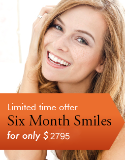 Image of a young woman smiling after using Six Month Smiles system