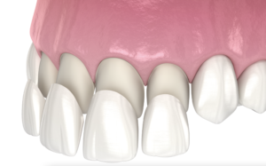 Image showing a model of upper teeth and veneers 